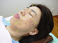 施術の様子3