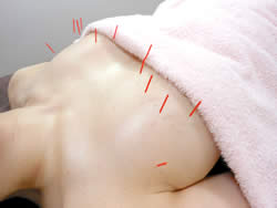 美乳はり（バストアップはり）