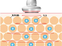 STEP.2 照射により脂肪組織内に気泡（キャビテーション）が作られます。