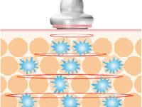 STEP.3 気泡が弾けたエネルギーにより脂肪を液化します。
